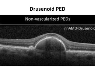 Drusenoid PED
 