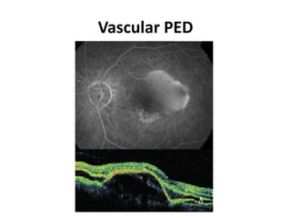 Vascular PED
 