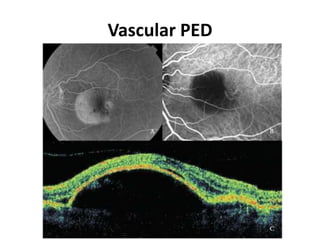 Vascular PED
 