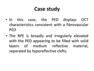 Case study
• In this case, the PED displays OCT
characteristics consistent with a fibrovascular
PED
• The RPE is broadly and irregularly elevated
with the PED appearing to be filled with solid
layers of medium reflective material,
separated by hyporeflective clefts.
 