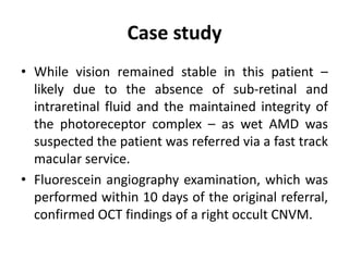Case study
• While vision remained stable in this patient –
likely due to the absence of sub-retinal and
intraretinal fluid and the maintained integrity of
the photoreceptor complex – as wet AMD was
suspected the patient was referred via a fast track
macular service.
• Fluorescein angiography examination, which was
performed within 10 days of the original referral,
confirmed OCT findings of a right occult CNVM.
 