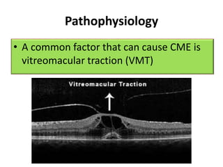 Pathophysiology
• A common factor that can cause CME is
vitreomacular traction (VMT)
 