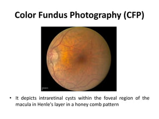 Color Fundus Photography (CFP)
• It depicts intraretinal cysts within the foveal region of the
macula in Henle's layer in a honey comb pattern
 