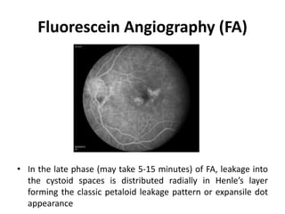 Fluorescein Angiography (FA)
• In the late phase (may take 5-15 minutes) of FA, leakage into
the cystoid spaces is distributed radially in Henle’s layer
forming the classic petaloid leakage pattern or expansile dot
appearance
 