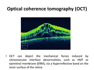Optical coherence tomography (OCT)
• OCT can depict the mechanical forces induced by
vitreomacular interface abnormalities, such as VMT or
epiretinal membrane (ERM), via a hyperreflective band on the
inner surface of the retina
 