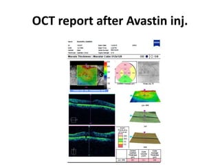 OCT report after Avastin inj.
 