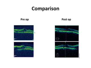 Comparison
Pre op Post op
 