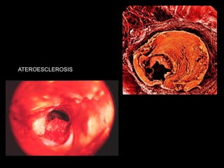 ATEROESCLEROSIS
 