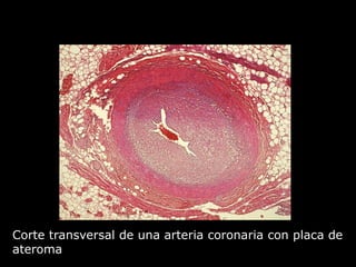 Corte transversal de una arteria coronaria con placa de
ateroma
 