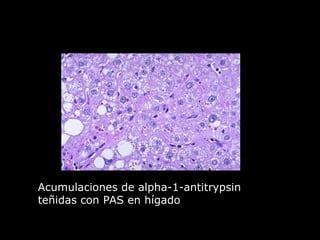 Acumulaciones de alpha-1-antitrypsin
teñidas con PAS en hígado
 