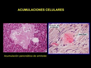 Acumulación pancreática de amiloide
ACUMULACIONES CELULARES
 