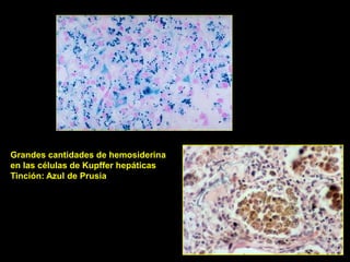 Grandes cantidades de hemosiderina
en las células de Kupffer hepáticas
Tinción: Azul de Prusia
 