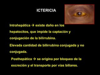 Intrahepática  existe daño en los
hepatocitos, que impide la captación y
conjugación de la bilirrubina.
Elevada cantidad de bilirrubina conjugada y no
conjugada.
Posthepática  se origina por bloqueo de la
excreción y el transporte por vías biliares.
ICTERICIA
 