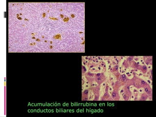 Acumulación de bilirrubina en los
conductos biliares del hígado
 