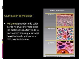 Acumulación de melanina
 Melanina: pigmento de color
pardo negruzco formado por
los melanocitos a través de la
enzima tirosinasa que cataliza
la oxidación de la tirosina a
dihidroxifenilalanina
 