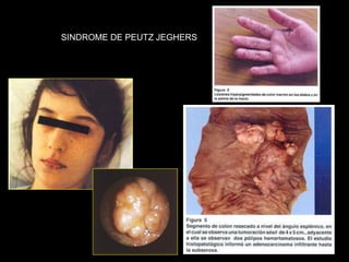 SINDROME DE PEUTZ JEGHERS
 