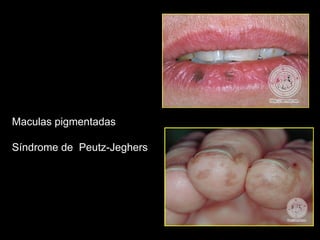 Maculas pigmentadas
Síndrome de Peutz-Jeghers
 