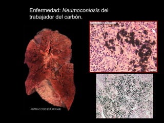 Enfermedad: Neumoconiosis del
trabajador del carbón.
 