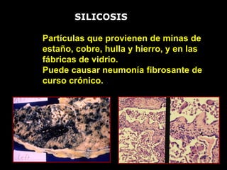 Partículas que provienen de minas de
estaño, cobre, hulla y hierro, y en las
fábricas de vidrio.
Puede causar neumonía fibrosante de
curso crónico.
SILICOSIS
 
