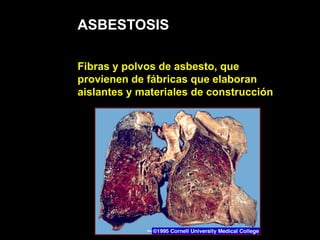 ASBESTOSIS
Fibras y polvos de asbesto, que
provienen de fábricas que elaboran
aislantes y materiales de construcción
 