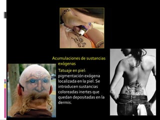 Acumulaciones de sustancias
exógenas
 Tatuaje en piel:
pigmentación exógena
localizada en la piel. Se
introducen sustancias
coloreadas inertes que
quedan depositadas en la
dermis.
 