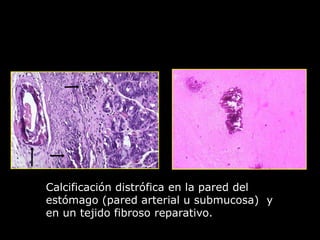 Calcificación distrófica en la pared del
estómago (pared arterial u submucosa) y
en un tejido fibroso reparativo.
 