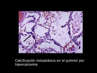 Calcificación metastásica en el pulmón por
hipercalcemia
 