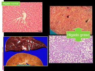 Higado graso
Higado normal
 