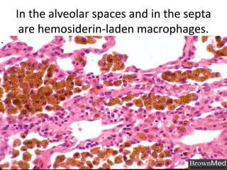 In the alveolar spaces and in the septa
are hemosiderin-laden macrophages.

 