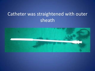 Catheter was straightened with outer
sheath
 