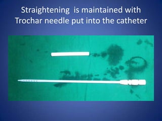 Straightening is maintained with
Trochar needle put into the catheter
 
