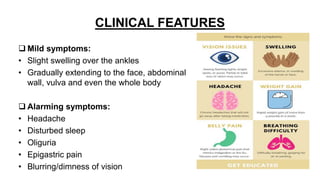 CLINICAL FEATURES
 Mild symptoms:
• Slight swelling over the ankles
• Gradually extending to the face, abdominal
wall, vulva and even the whole body
 Alarming symptoms:
• Headache
• Disturbed sleep
• Oliguria
• Epigastric pain
• Blurring/dimness of vision
 