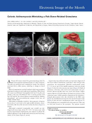 Electronic Image of the Month

Colonic Actinomycosis Mimicking a Fish Bone–Related Granuloma

YUN–CHENG HSIEH,*,‡ YU–YAO CHANG,§,ʈ and KUEI–CHUAN LEE*,‡
*Division of Gastroenterology, Department of Medicine, §Division of Colon and Rectal Surgery, Department of Surgery, Taipei Veterans General
Hospital, Taipei; and ‡Department of Medicine, and ʈDepartment of Surgery, National Yang-Ming University School of Medicine, Taipei, Taiwan




A      78-year-old woman visited the gastroenterology clinic for
      right lower-quadrant abdominal pain of 3 days’ duration.
The pain was persistent and cramping in nature, but without
                                                                            Laparotomy was performed under a preoperative diagnosis of
                                                                         ﬁsh bone–related small-bowel perforation with foreign body
                                                                         granuloma. An encapsulated, yellowish, extraluminal tumor
associated fever, chills, nausea, vomiting, or change in bowel           6 ϫ 3.5 cm in size in the middle transverse colon was found
habit.                                                                   (Figure C), but the colon mucosa was intact (Figure D). Radical
   Physical examination revealed localized right lower-quadrant          transverse colectomy with end-to-end anastomosis was per-
abdominal tenderness with mild muscle guarding. White blood              formed. Microscopically, there was acute and chronic inﬂam-
cell count was 6500/mm3, hemoglobin level was 11.6 g/dL, and             mation, ﬁbrosis, and microabscess formation in sections of the
platelet count was 191,000/mm3. Her C-reactive protein level             subserosal mass. Sulfur granules characterized by Splendore–
was 0.87 mg/dL, but serum alanine aminotransferase, alkaline             Hoeppli phenomenon were also identiﬁed in the H&E stain
phosphatase, and carcinoembryonic antigen levels were all
                                                                         (Figure E), and ﬁlamentous bacteria were shown by Gram stain
within normal range.
                                                                         (Figure F) and Grocott’s methenamine silver stain (Figure G).
   Abdominal sonography revealed a heterogeneous echogenic
                                                                         These ﬁndings were compatible with actinomycosis. There was
lesion about 3 cm in size in the right middle abdomen, associ-
ated with a ﬁsh bone–like structure within the lesion (Figure A,         no ﬁsh bone found in the specimen. The patient received
arrows).
   Abdominal computed tomography scan revealed an oval-                  Conﬂicts of interest
shaped soft-tissue mass, about 38 ϫ 20 ϫ 22 mm in size, with               The authors disclose no conﬂicts.
interior linear-shaped hyperdensity and adjacent localized ill-                                 © 2012 by the AGA Institute
deﬁned inﬁltrates in the small-bowel mesentery and focal irreg-                                      1542-3565/$36.00
ularity of the ileum (Figure B, arrows).                                                http://dx.doi.org/10.1016/j.cgh.2012.06.028

                                                                        CLINICAL GASTROENTEROLOGY AND HEPATOLOGY 2012;10:e81– e82
 