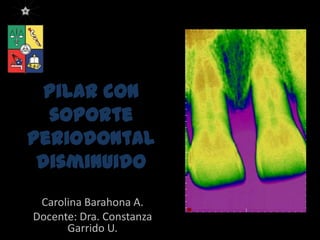 Pilar con
soporte
periodontal
disminuido
Carolina Barahona A.
Docente: Dra. Constanza
Garrido U.
Facultad de Odontología – Universidad de Chile
 
