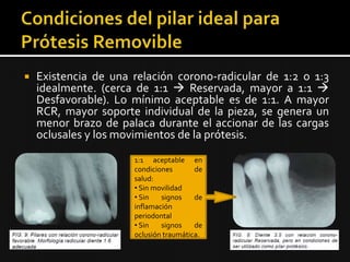  Existencia de una relación corono-radicular de 1:2 o 1:3
idealmente. (cerca de 1:1  Reservada, mayor a 1:1 
Desfavorable). Lo mínimo aceptable es de 1:1. A mayor
RCR, mayor soporte individual de la pieza, se genera un
menor brazo de palaca durante el accionar de las cargas
oclusales y los movimientos de la prótesis.
1:1 aceptable en
condiciones de
salud:
• Sin movilidad
• Sin signos de
inflamación
periodontal
• Sin signos de
oclusión traumática.
 