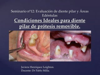 {
Seminario nº12: Evaluación de diente pilar y Áreas
Edéntulas
Condiciones Ideales para diente
pilar de prótesis removible.
Javiera Henríquez Leighton.
Docente: Dr Pablo Milla.
 
