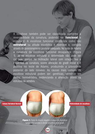 A escoliose também pode ser classiﬁcada conforme a
reversibilidade da curvatura, podendo ser funcional e
estrutural. A escoliose funcional conhecida como não
estrutural ou atitude escoliótica é reversível e, corrigida
através do posicionamento postural adequado. No teste de Adams
a curvatura da escoliose funcional desaparece (Figura
1). Já na escoliose estrutural a deformidade não pode ser
corrigida, porque há inclinação lateral com rotação ﬁxa e
irreversível da curvatura, ocorre alteração do gradil costal e é
positiva no teste de Adams, produzindo a gibosidade
posterior do lado convexo. As causas mais comuns da
escoliose estrutural podem ser: genéticas, vértebras em
cunha, hemivértebra, evidenciando a alteração óssea na
estrutura da vértebra.
Figura 1: Teste de Adams negativo à esquerda (escoliose
funcional) e positivo à direita (escoliose estrutural).
Coluna Vertebral Normal Deformidade de escoliose
03
 