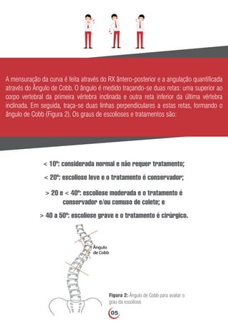 A mensuração da curva é feita através do RX ântero-posterior e a angulação quantiﬁcada
através do Ângulo de Cobb. O ângulo é medido traçando-se duas retas: uma superior ao
corpo vertebral da primeira vértebra inclinada e outra reta inferior da última vértebra
inclinada. Em seguida, traça-se duas linhas perpendiculares a estas retas, formando o
ângulo de Cobb (Figura 2). Os graus de escolioses e tratamentos são:
< 10º: considerada normal e não requer tratamento;
< 20º: escoliose leve e o tratamento é conservador;
> 20 e < 40º: escoliose moderada e o tratamento é
conservador e/ou comuso de colete; e
> 40 a 50º: escoliose grave e o tratamento é cirúrgico.
Figura 2: Ângulo de Cobb para avaliar o
grau da escoliose
05
 