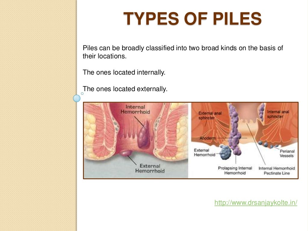Piles Surgeon in Pune
