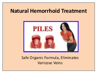 Natural Hemorrhoid Treatment
Safe Organic Formula, Eliminates
Varicose Veins
 