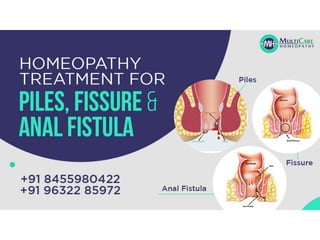 Best homeopathy fissure homeopathy doctor in Bhubaneswar