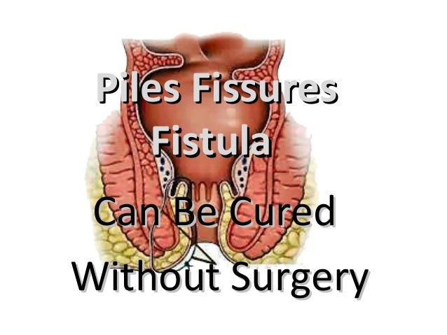 pic Piles And Fissures Real Photos piles fissures fistula