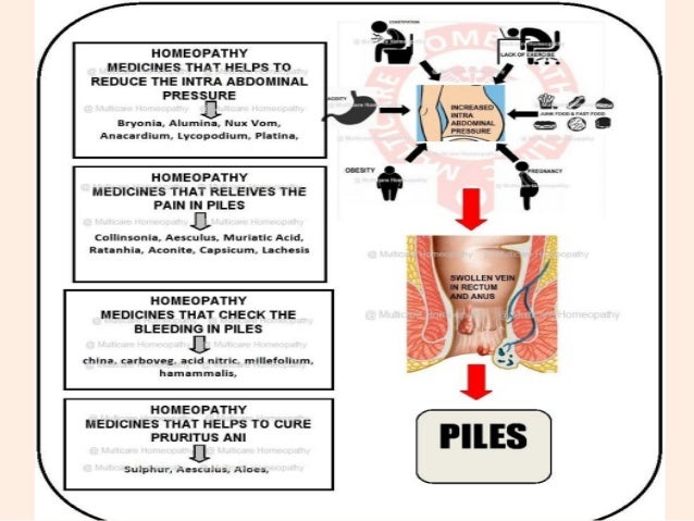 How To Cure Piles Naturally And Permanently Without Surgery
