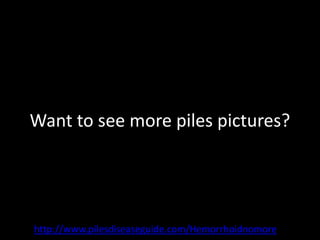 Want to see more piles pictures?




http://www.pilesdiseaseguide.com/Hemorrhoidnomore
 