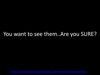 You want to see them..Are you SURE?




  http://www.pilesdiseaseguide.com/Hemorrhoidnomore
 