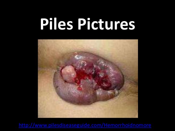 Piles pictures