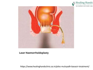 Plies Hospital | hospital for bavasir| healing hands clinic | PPTX