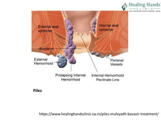 Plies Hospital | hospital for bavasir| healing hands clinic | PPTX