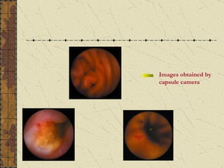 Images obtained by
capsule camera
 