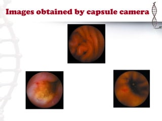 Images obtained by capsule camera
 